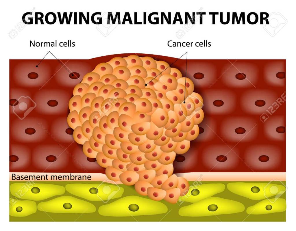32719838-cancer-cells-in-a-growing-malignant-tumor-malignant-neoplasm-metastasis